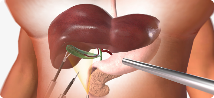 A close-up view of a medical procedure showing surgical tools being used to operate on a human liver and gallbladder.