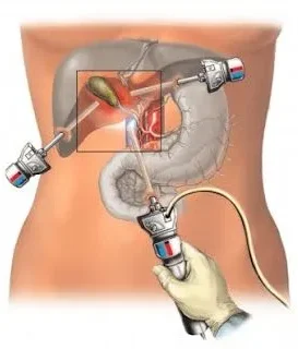 Laparoscopic gallbladder surgery illustration