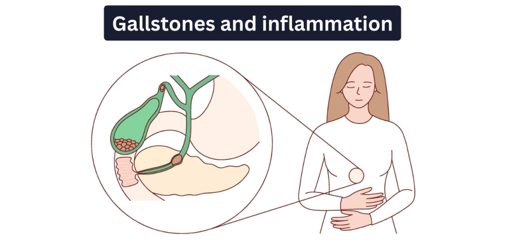 Medical diagram of gallstones and inflamed gallbladder causing abdominal pain