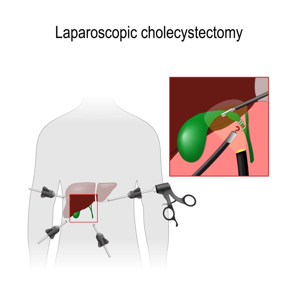 Illustration of laparoscopic cholecystectomy procedure