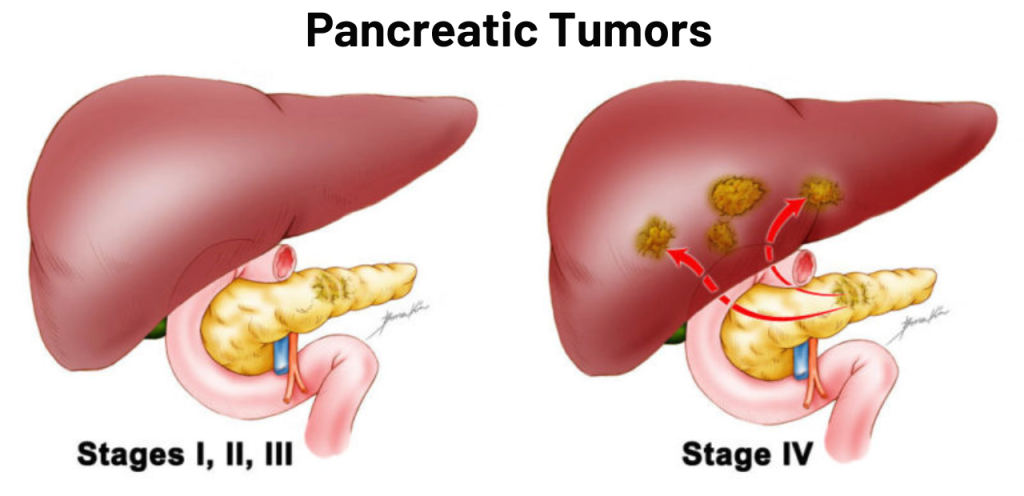 “Diagram of pancreatic tumors showing stages and spread to nearby organs”