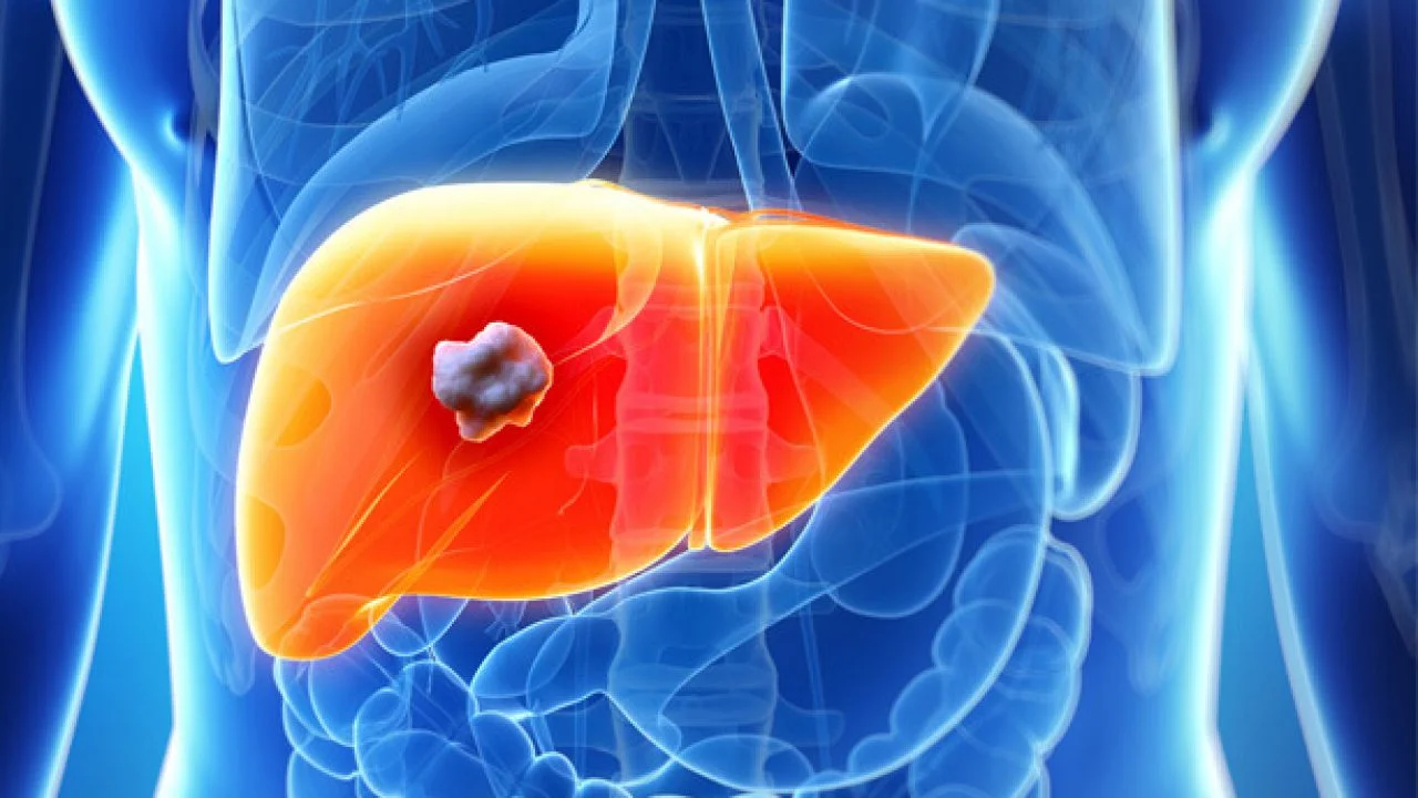 A 3D medical illustration of a human torso, with a glowing, enlarged liver in orange and a clearly visible tumor in gray and white on its surface, set against a blue, semi-transparent background.