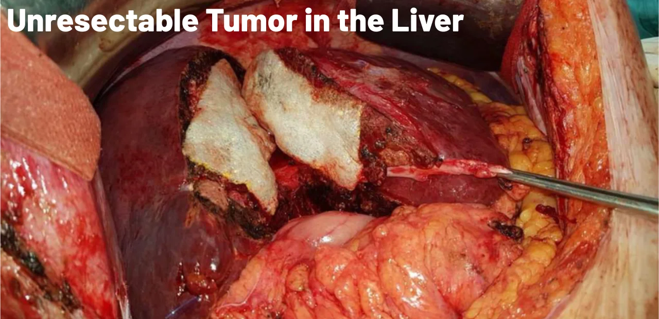 Surgeon for Unresectable Tumor in the Liver