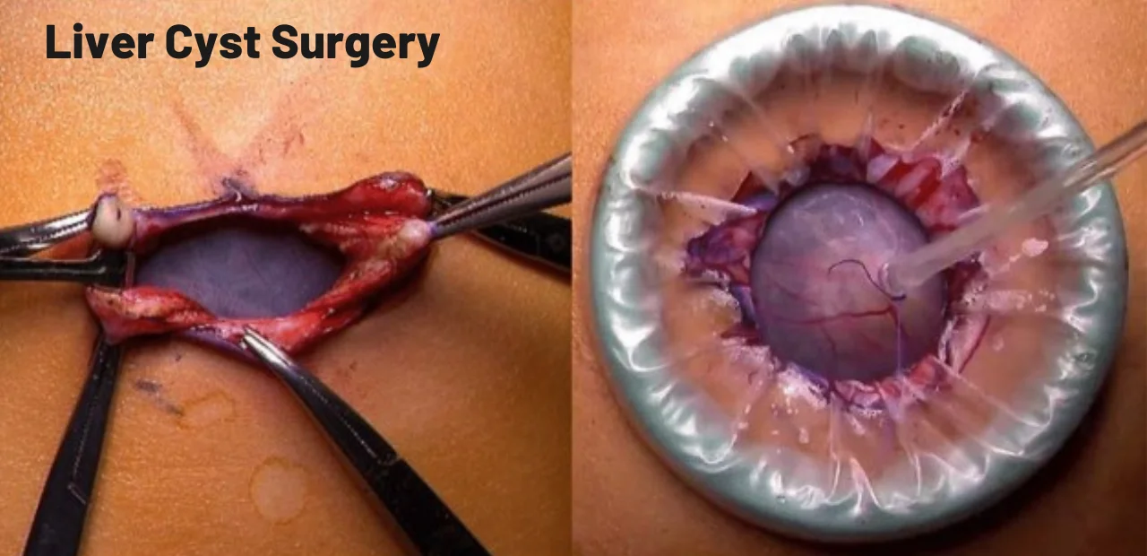 Liver Cyst Surgeon