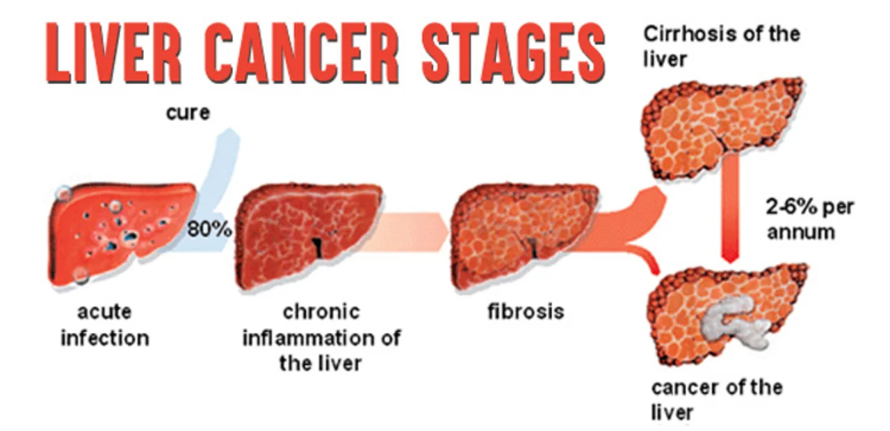 Liver cancer stages from infection to cancer