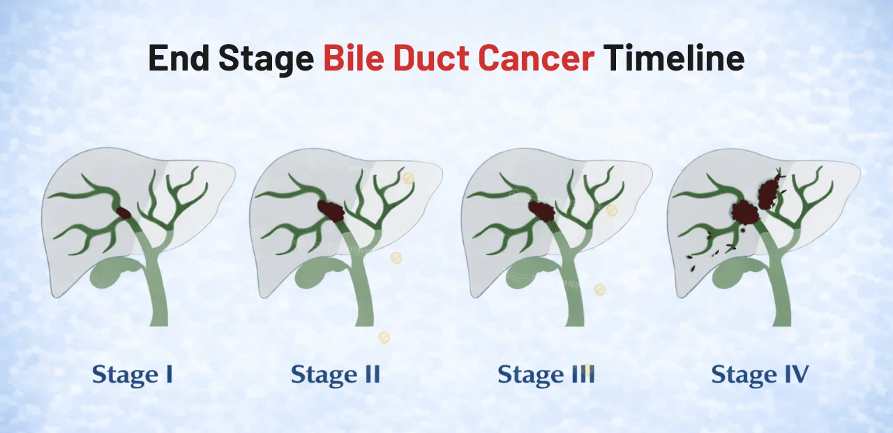 End Stage Bile Duct Cancer Timeline