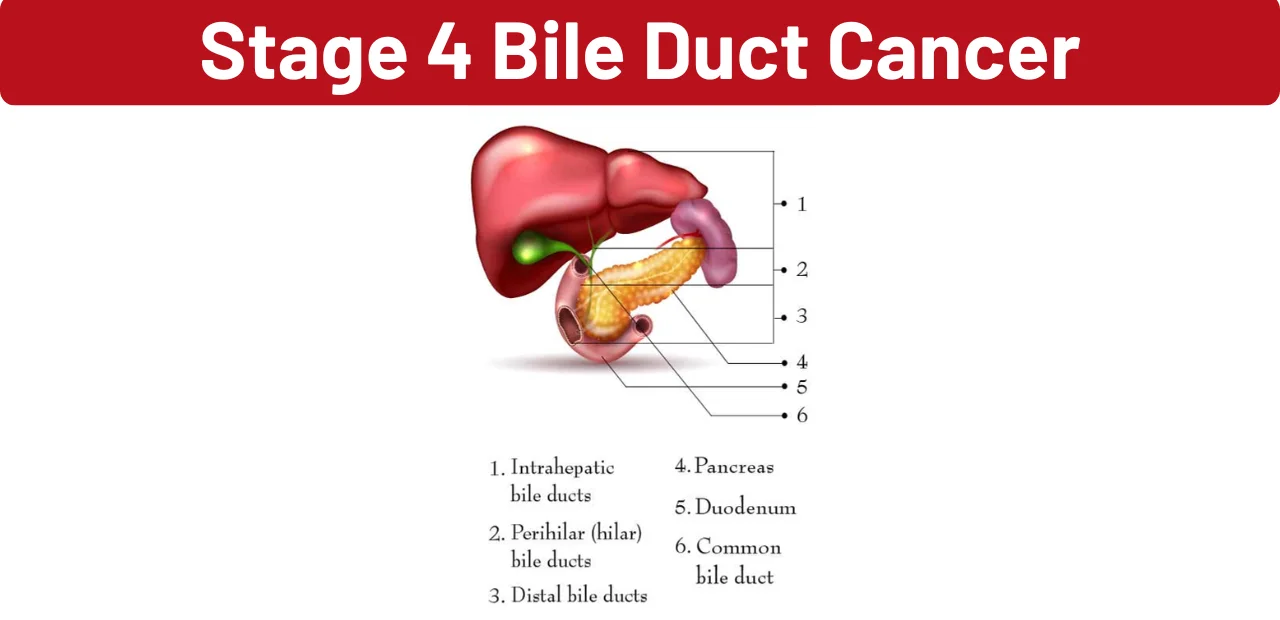 Stage 4 Bile Duct Cancer
