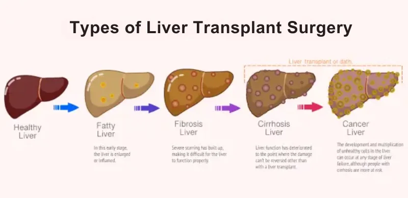 Liver Care Center – Dr. Muhammad Zakria (Liver Specialist in Lahore) Types of Liver Transplant Surgery