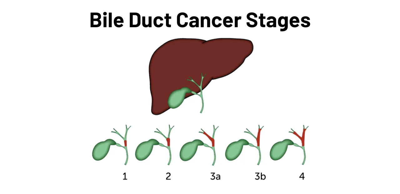 Bile Duct Cancer Stages