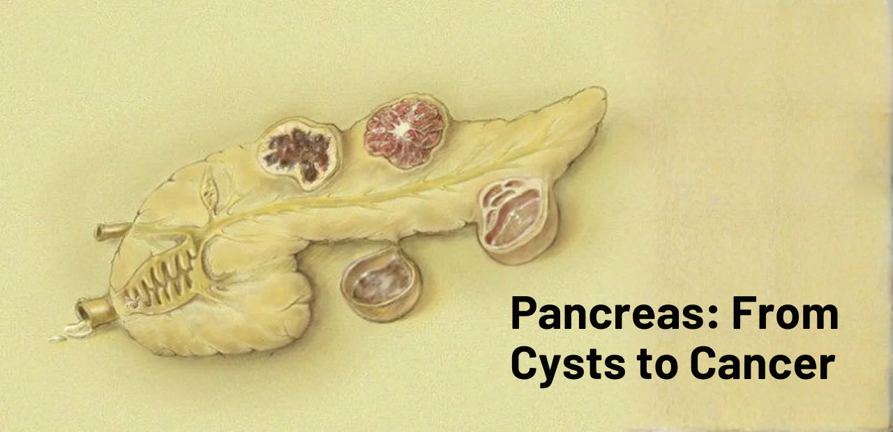 Liver Care Center – Dr. Muhammad Zakria (Liver Specialist in Lahore) “Illustration showing pancreas with cysts and cancer development stages”