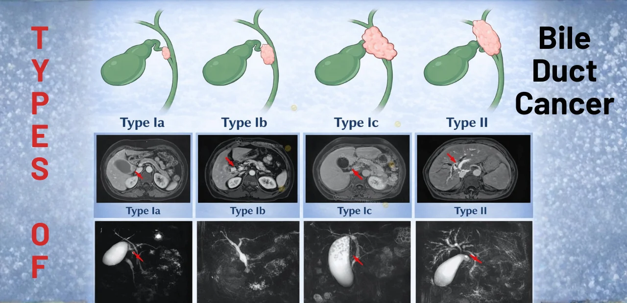 bile duct cancer types imaging classification
