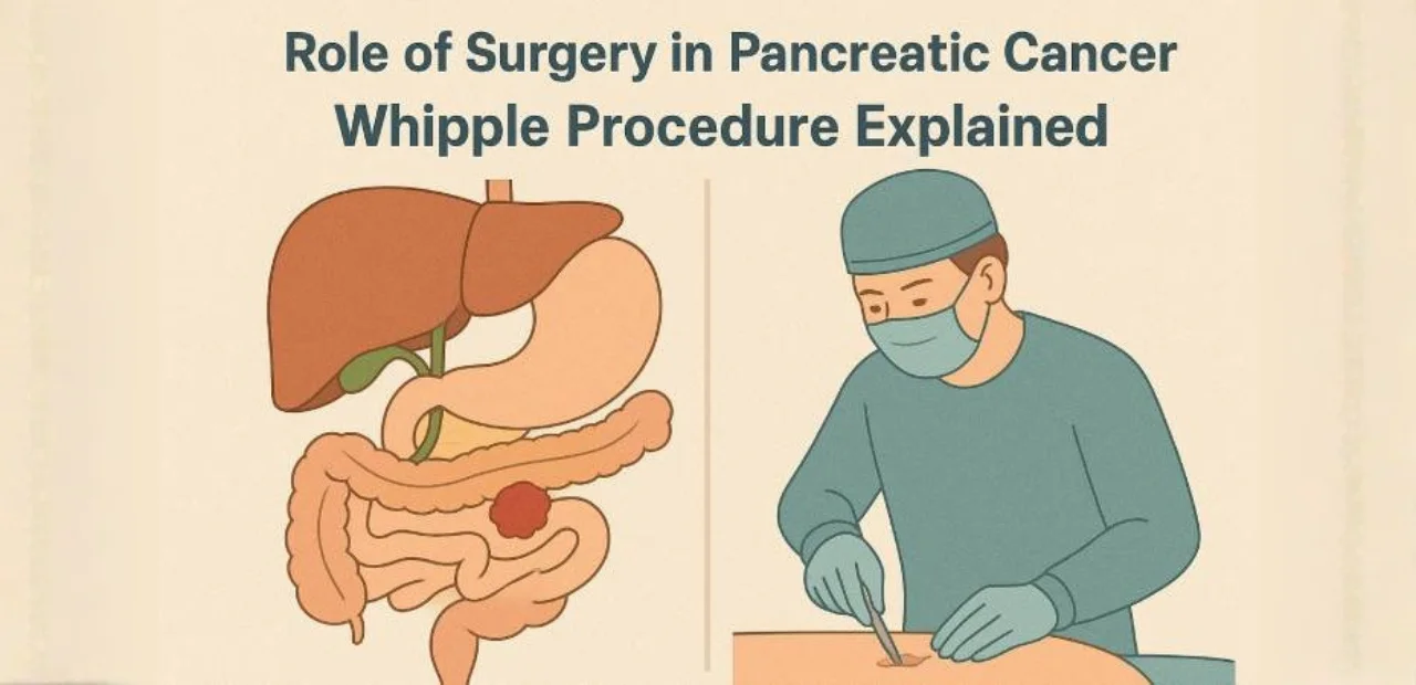 “Whipple procedure surgery illustration for pancreatic cancer treatment”